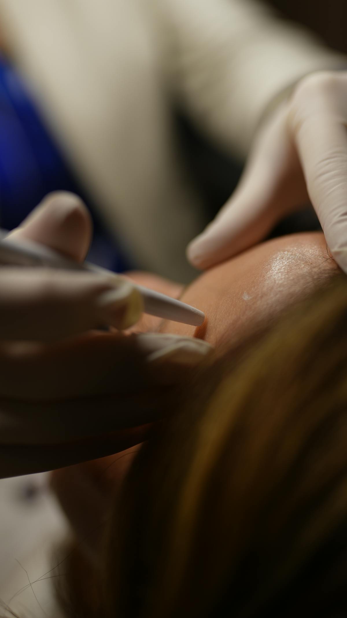 Diamantslibning & microneedling