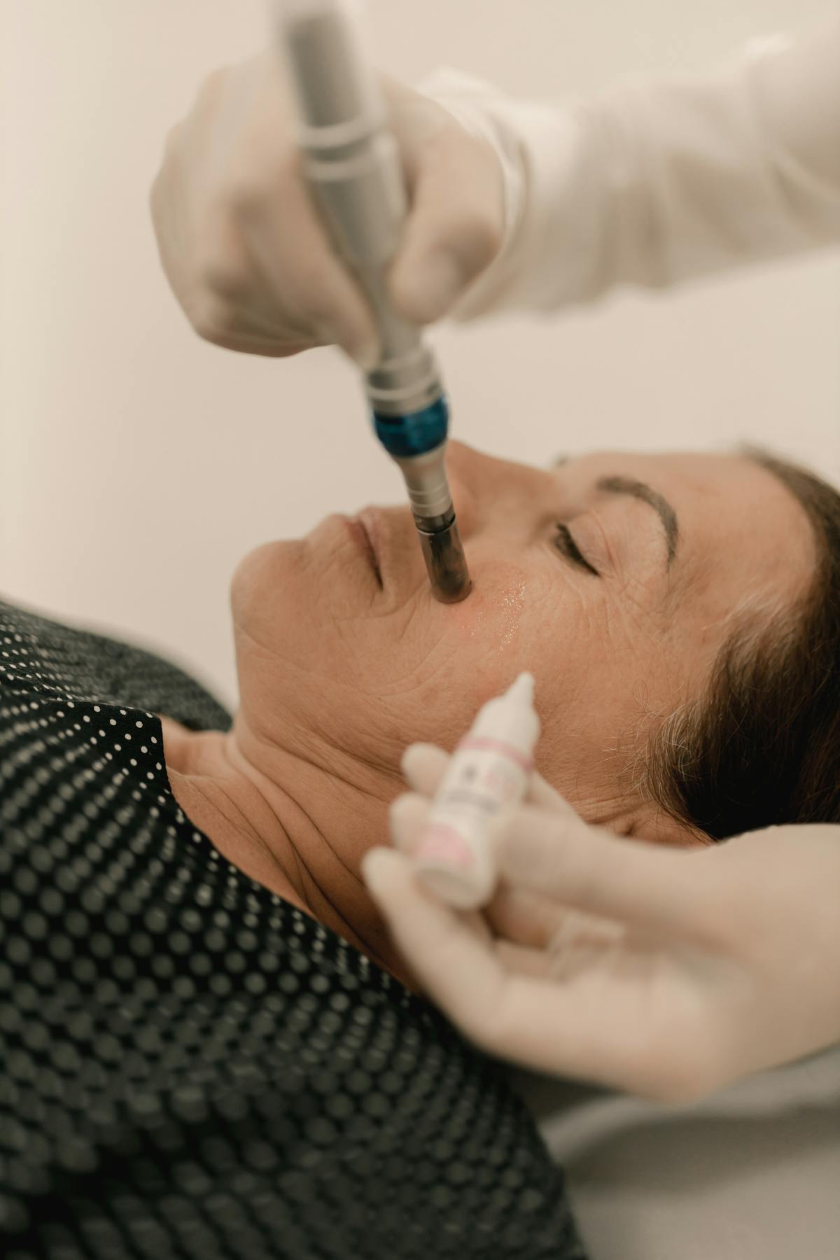 Microneedling — Ansigt